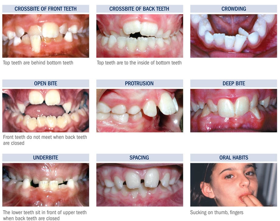 Can I Get Braces on Just My Bottom Teeth - Orthodontics Liited